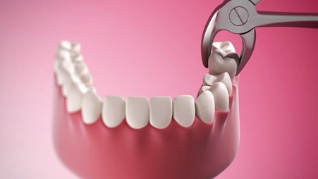 Read more about the article Dental Extraction Treatment