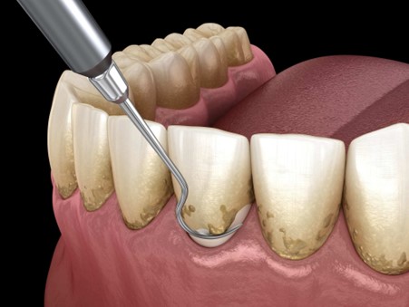 Read more about the article Dental Scaling Treatment