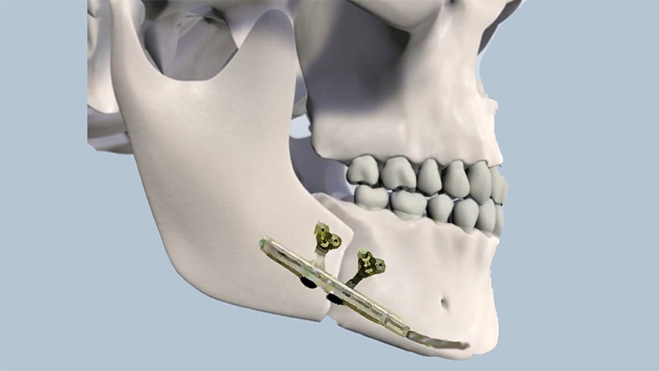 Read more about the article Distraction Osteogenesis