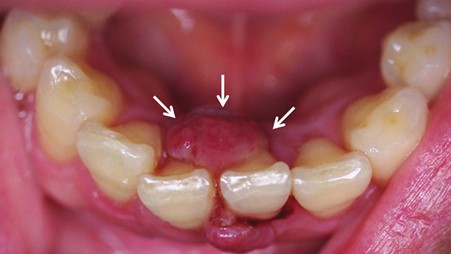 Read more about the article Oral Pathalogy