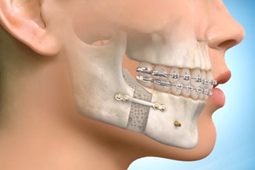 Read more about the article Orthognathic Surgery ( Jaw Surgery )