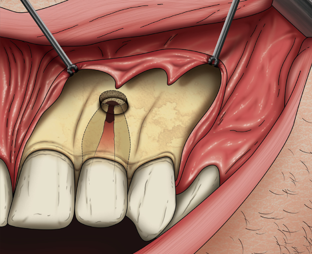 Read more about the article Periapicial Surgery