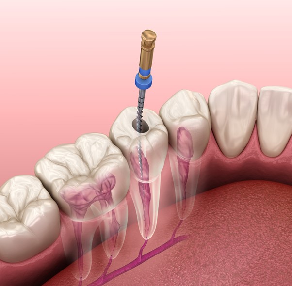 Read more about the article Root Canal Treatment
