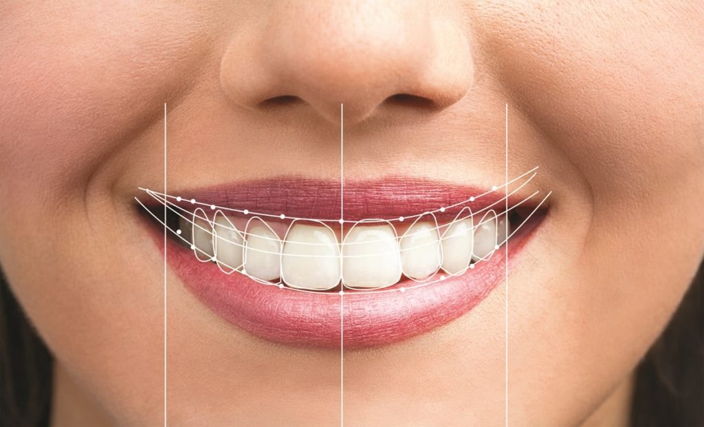 Read more about the article Smile Design