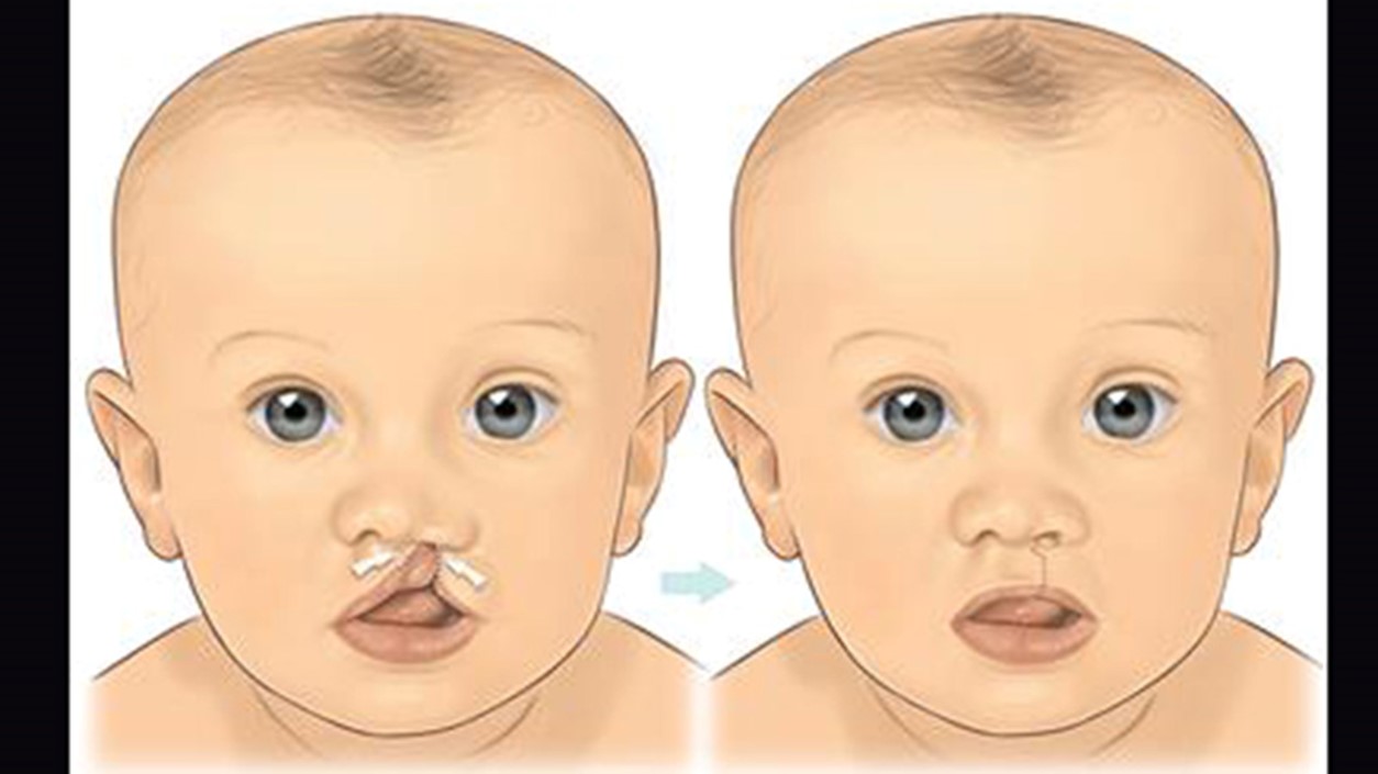 You are currently viewing Cleft Lip Treatment