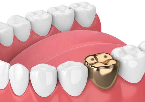 Read more about the article Dental Restoration Treatment