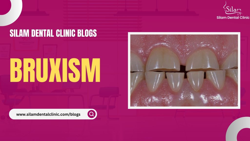 Read more about the article Bruxism