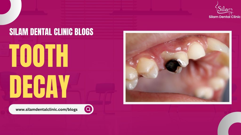 Read more about the article Tooth Decay